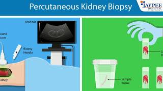 Understanding Kidney Biopsies Why They’re Done amp How They Work [upl. by Neelhtakyram]