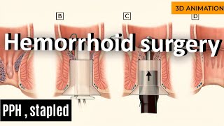 PPH Stapled Hemorrhoid Surgery [upl. by Nahtanoj494]