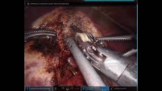 ROBOTIC ANATOMICAL RIGHT HEPATECTOMY AND DISTAL PANCREATECTOMY FOR OLIGOMETASTATIC PANCREAS ADENOCAR [upl. by Yolande]