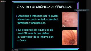 Gastritis 629 [upl. by Grous]