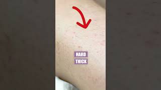 Difference Between Acne And Ingrown Hair [upl. by Alys]