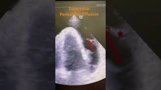 Tubercular pericardial effusion echo radiology tb cardiology [upl. by Aimit383]