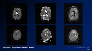 Intracranial infections  3  Focal Infections [upl. by Laeria]