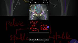 Pelvic fracture and Pelvic binder application [upl. by Cordle169]