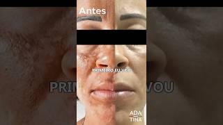 Existe remédio para melasma [upl. by Suidaht76]