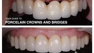 Porcelain Crowns and Bridges [upl. by Eniarral]