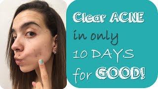 How I Cleared My Acne In 10 Days with natural ways [upl. by Haldane]