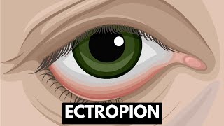 Ectropion Causes Symptoms Complications And Treatment [upl. by Wang161]