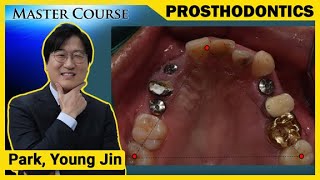 Master Course Season2 PROSTHODONTICS Bite Registration [upl. by Thorman]