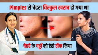 Get Rid of Pimples amp Acne Permanently  AcnePimples and Open Pores Treatment Patient REVIEW [upl. by Aivart]