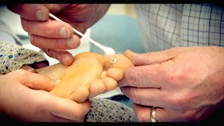 Freezing a HUGE PLANTAR WART with liquid nitrogen  Dr Paul [upl. by Aldon187]