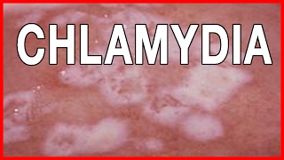 Signs and Symptoms of Chlamydia  How to Treat Chlamydia in Women and Men [upl. by Gaulin]