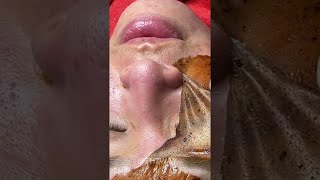 Amazing blackhead removal by Brown mask blackheadsremoval relaxingtriggers skincare [upl. by Lazare]