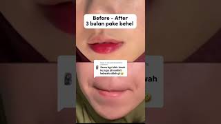 Beforeafter 3 Bulan Pake Behel [upl. by Akselav]