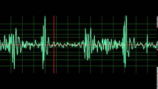 Prosthetic Valve Aortic Valve Mitral Regurgitation normal speed [upl. by Snehpets]