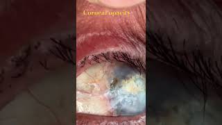 Corneal opacity after keratoplasty [upl. by Pearman991]