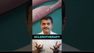 Varicose Vein REMOVAL by Injection shortvideos veinspecialist veins [upl. by Yrrek905]