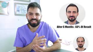 Hair transplant lebanon I Before after I Dr Ibrahim Jebai I نتيجة زراعة الشعر في لبنان [upl. by Gaillard]