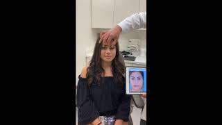 Rhinoplasty Results for a Droopy Tip Nose  Anthony Bared MD FACS Miami FL [upl. by Pudens377]