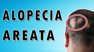 Causes and Treatment of Hair Loss  Alopecia Areata [upl. by Faulkner]