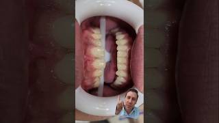 🔴ANTES E DEPOIS FACETAS CASO Extremo🙀diastemas conóides e ausência de laterais dentist [upl. by Troth]