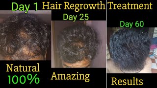 Amazing result hair regrowth new natural treatment [upl. by Jaycee377]