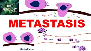 NEOPLASIA 8 INVASION AND METASTASIS Mechanisms Pathways of Spread [upl. by Zeuqirdor774]