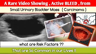 Urinary Bladder mass with Active bleeding Captured in Video  Risk Factors [upl. by Audres]