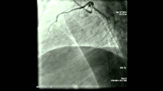 Coronary angiography procedure [upl. by Veejar524]