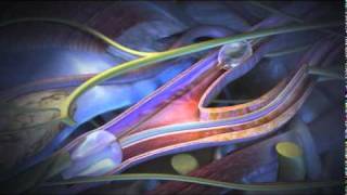 Angioplasty Stenting Atherectomy and Thrombolysis [upl. by Mera]