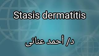 5 Stasis dermatitis by Dr Ahmed Anany [upl. by Martyn928]