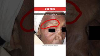 Hansens Disease Leprosy tcml shorts [upl. by Antin362]