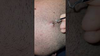 I pulled this out of my boyfriends beard today pimples pop fy fyp pimple onthisday pieface [upl. by Zealand]