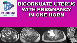 Bicornuate uterus with pregnancy in one horn [upl. by Esyahc777]