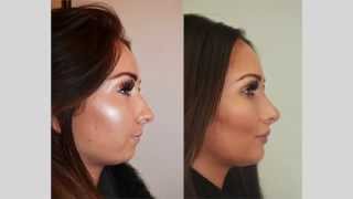 Rhinoplasty Review Selfie amp Testimonial [upl. by Adekahs]