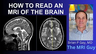 How to read an MRI of the brain  First Look MRI [upl. by Ysor]