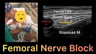 Femoral Nerve Block  Ultrasound Guided [upl. by Eiaj]