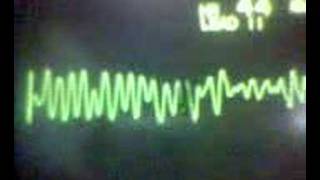 ECG Video Ventricular Fibrillation [upl. by Ashford]