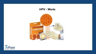 HPV  Warts [upl. by Elwaine]