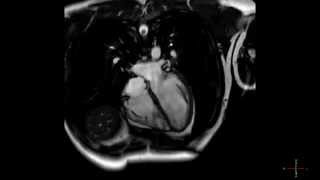 Cardiac MRI scan of a heart beating in high resolution  ECG gated CMRI in HD  real time scan [upl. by Emmery]