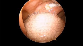 Tonsil stone removal using cotton swabs [upl. by Nygem995]