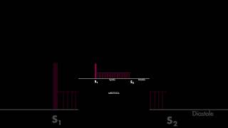 Holosystolic murmur [upl. by Reade]