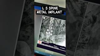 L s spine metal implant radiologycareer motivation lsspinelumberspine trendingshortsviralshort [upl. by Rad]