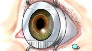 Malpractice Medical Lasik Laser Eye Surgery 3 [upl. by Alenairam]