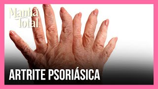 Conheça o novo tratamento aprovado para a artrite psoriásica  MANHÃ TOTAL [upl. by Brandes]