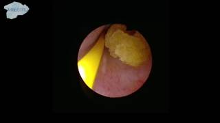 Localization of the ureter stone [upl. by Benyamin597]