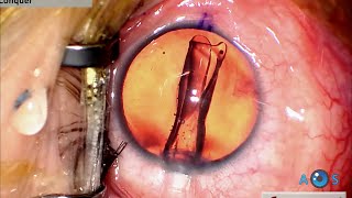 Visian ICL EVO Toric for High Myopic Astigmatism Lens Loading and Surgical Technique Guide [upl. by Danika]