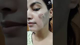 TCA Peel Remove 5th Day Chemical peel remove [upl. by Aihtak]