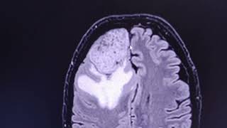 Aggressive meningioma  CT venogram and MRI [upl. by Nefets]