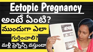 ectopic pregnancy in Telugu ectopicpregnancy pregnancy pregnant pcos pcod pcoddiet thyroid [upl. by Nassah731]